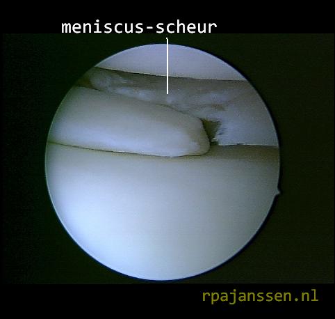Meniscus-scheur bij kijkoperatie