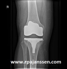 Low infection rate after knee arthroplasty