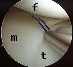 Knee arthroscopy with meniscus repair (f=femur, m=meniscus, t=tibia)